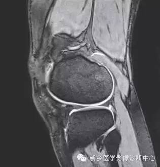 膝关节断层解剖+详细标注