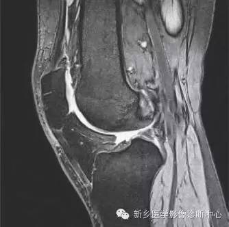 膝关节断层解剖+详细标注