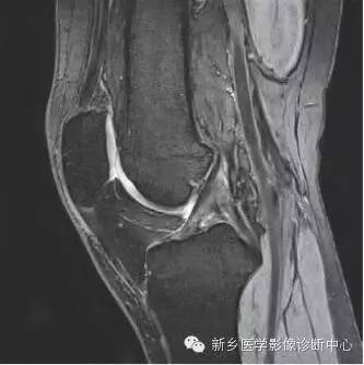 膝关节断层解剖+详细标注