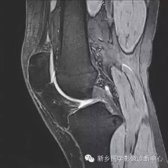 膝关节断层解剖+详细标注