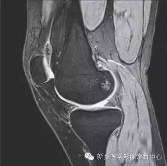 膝关节断层解剖+详细标注