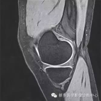 膝关节断层解剖+详细标注