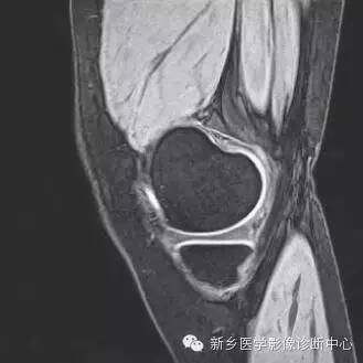 膝关节断层解剖+详细标注