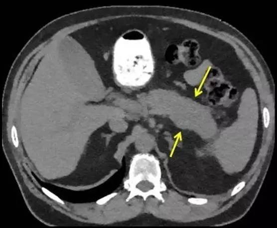 【病例】自身免疫性胰腺炎1例CT及MR诊断要点