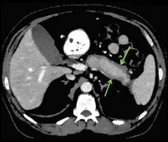 【病例】自身免疫性胰腺炎1例CT及MR诊断要点
