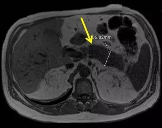 【病例】自身免疫性胰腺炎1例CT及MR诊断要点