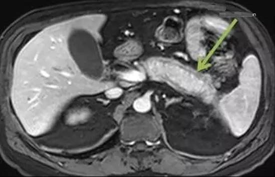 【病例】自身免疫性胰腺炎1例CT及MR诊断要点