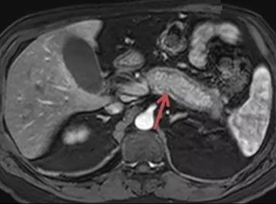 【病例】自身免疫性胰腺炎1例CT及MR诊断要点