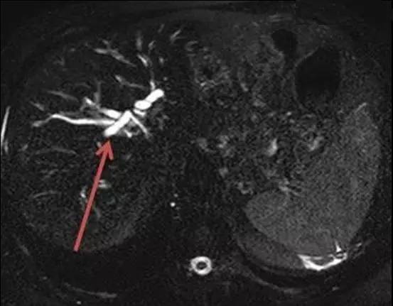 【病例】自身免疫性胰腺炎1例CT及MR诊断要点