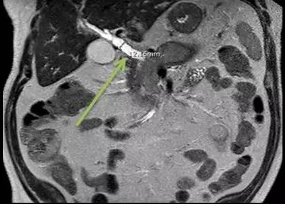 【病例】自身免疫性胰腺炎1例CT及MR诊断要点