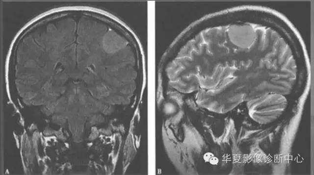 一个口诀让你牢记脑膜瘤 一个口诀让你牢记脑膜瘤