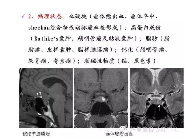 【PPT】鞍区T1WI高信号原因分析