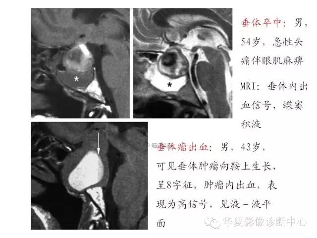 【PPT】鞍区T1WI高信号原因分析