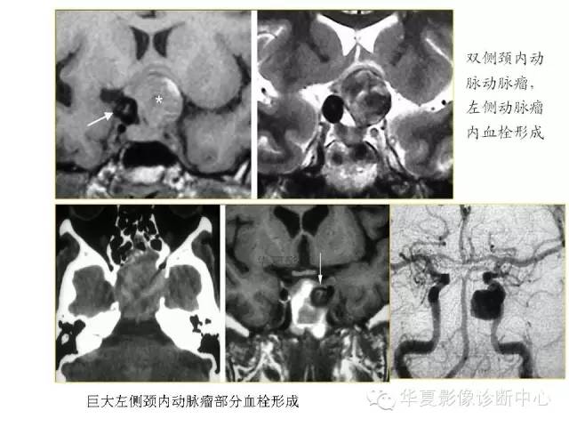 【PPT】鞍区T1WI高信号原因分析