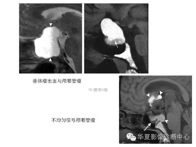 【PPT】鞍区T1WI高信号原因分析