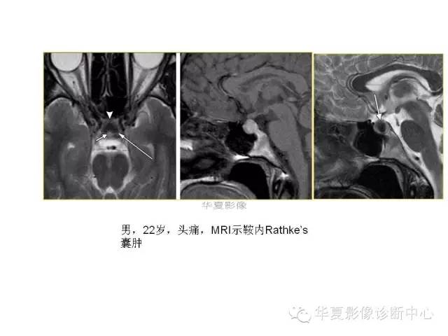【PPT】鞍区T1WI高信号原因分析