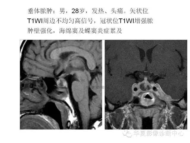 【PPT】鞍区T1WI高信号原因分析