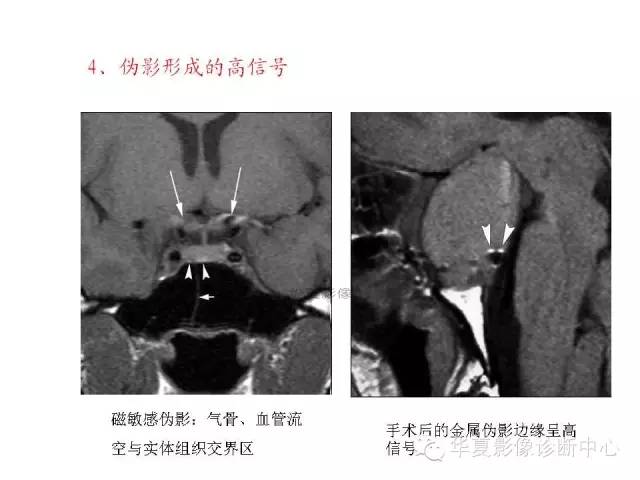 【PPT】鞍区T1WI高信号原因分析