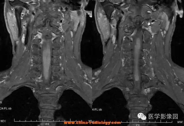 【病例】脊髓室管膜瘤1例MR影像表现