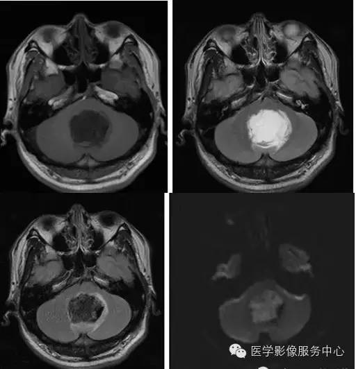 皮样囊肿与表皮样囊肿如何鉴别