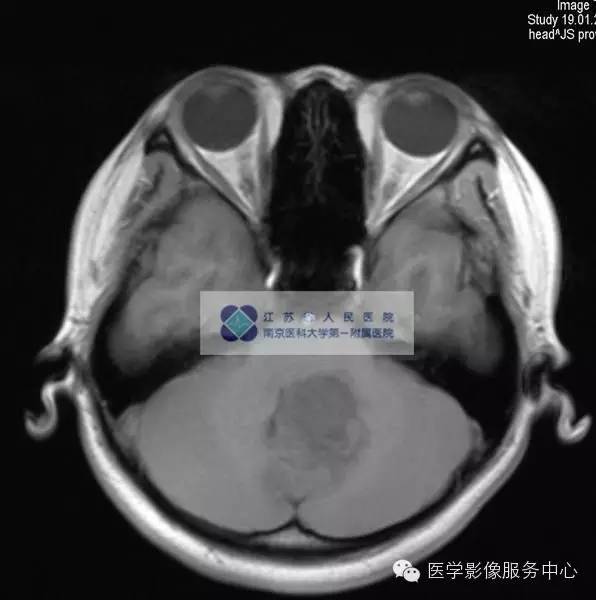 【病例】髓母细胞瘤1例MR影像表现