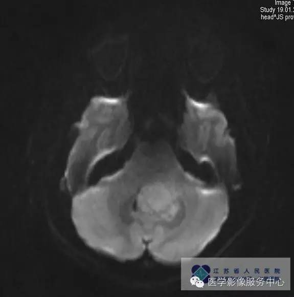 【病例】髓母细胞瘤1例MR影像表现 【病例】髓母细胞瘤1例MR影像表现