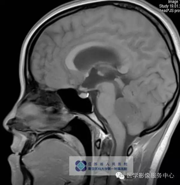 【病例】髓母细胞瘤1例MR影像表现 【病例】髓母细胞瘤1例MR影像表现
