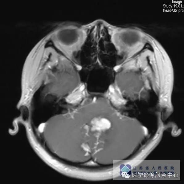 【病例】髓母细胞瘤1例MR影像表现 【病例】髓母细胞瘤1例MR影像表现