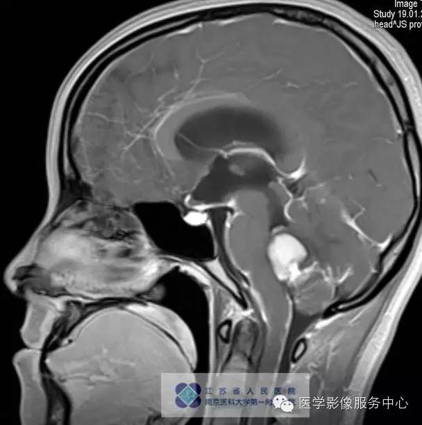 【病例】髓母细胞瘤1例MR影像表现 【病例】髓母细胞瘤1例MR影像表现