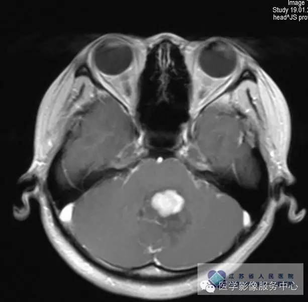【病例】髓母细胞瘤1例MR影像表现 【病例】髓母细胞瘤1例MR影像表现