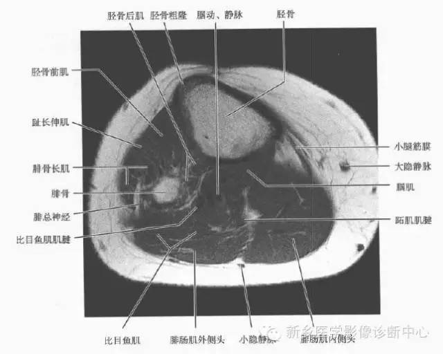 小腿部断层解剖+详细标注