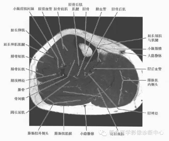 小腿部断层解剖+详细标注