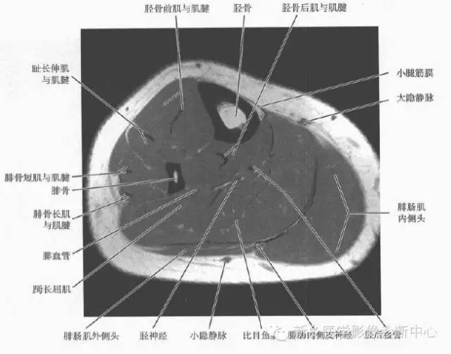小腿部断层解剖+详细标注