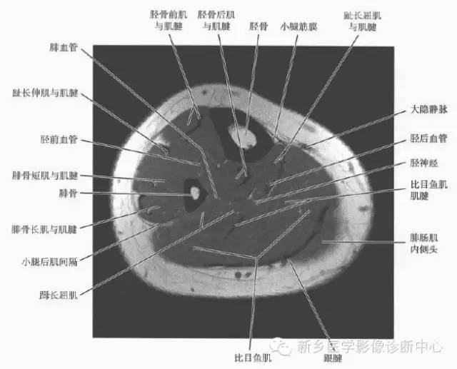 小腿部断层解剖+详细标注