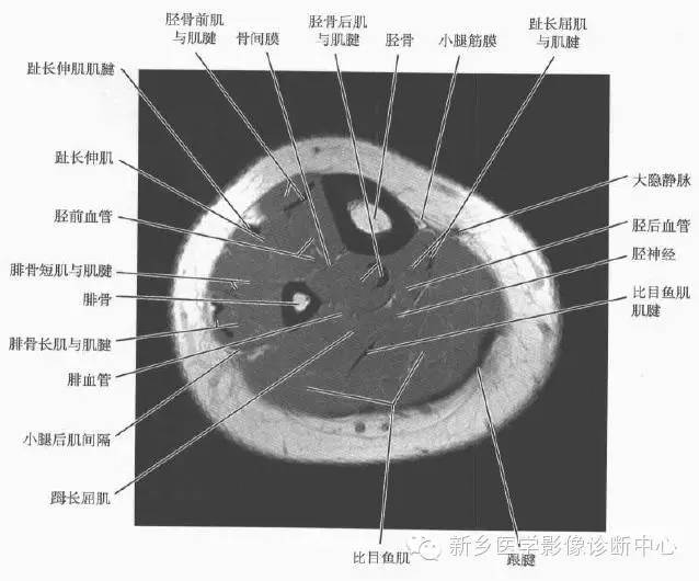 小腿部断层解剖+详细标注