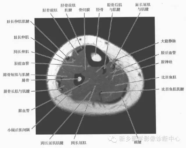 小腿部断层解剖+详细标注