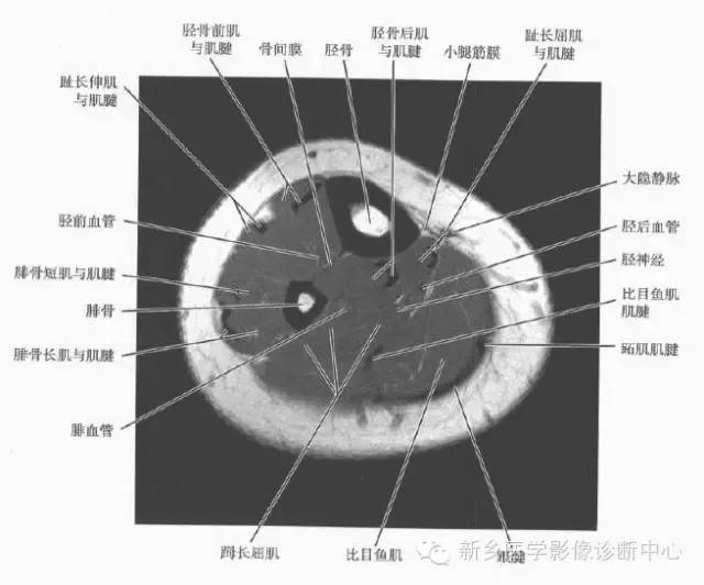 小腿部断层解剖+详细标注