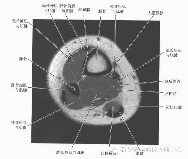 小腿部断层解剖+详细标注
