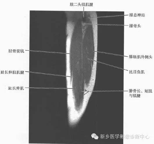 小腿部断层解剖+详细标注