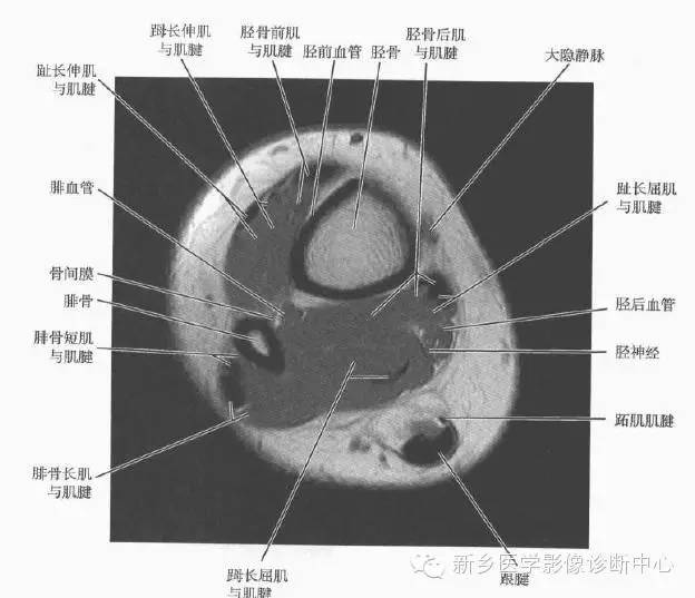 小腿部断层解剖+详细标注