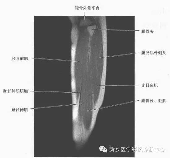 小腿部断层解剖+详细标注