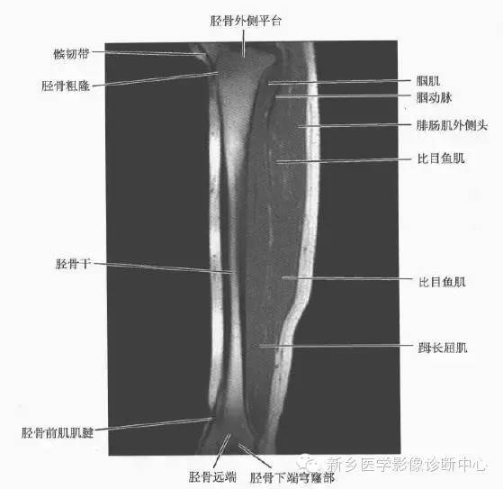小腿部断层解剖+详细标注
