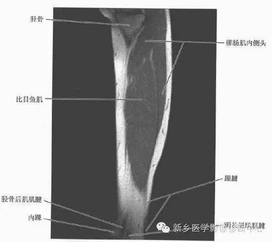 小腿部断层解剖+详细标注