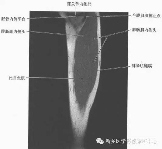 小腿部断层解剖+详细标注