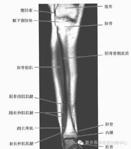 小腿部断层解剖+详细标注