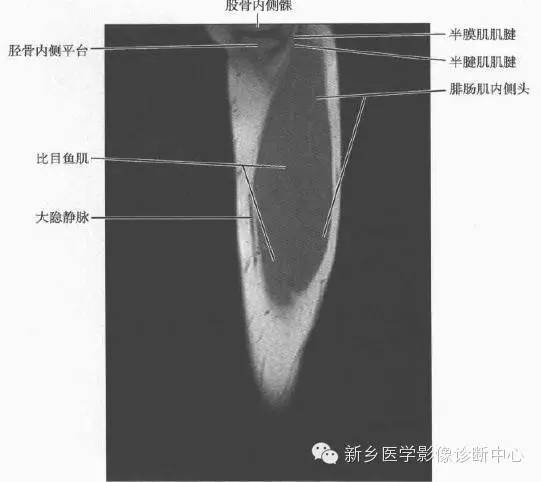 小腿部断层解剖+详细标注