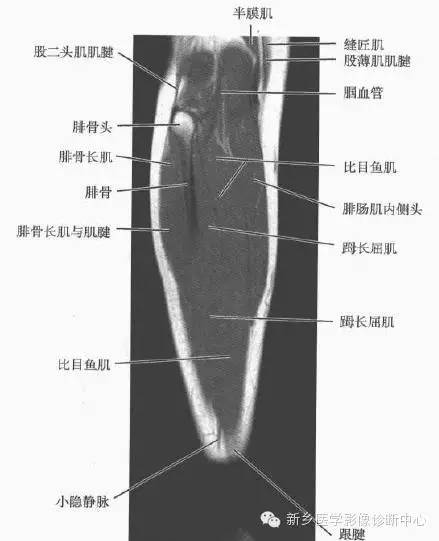 小腿部断层解剖+详细标注