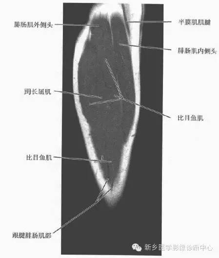 小腿部断层解剖+详细标注