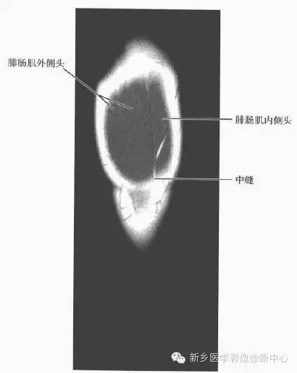 小腿部断层解剖+详细标注
