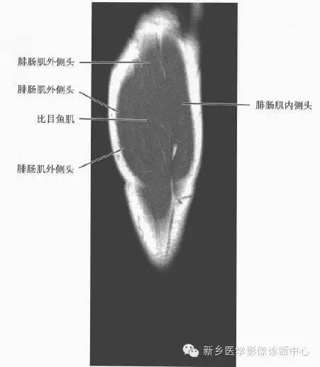 小腿部断层解剖+详细标注